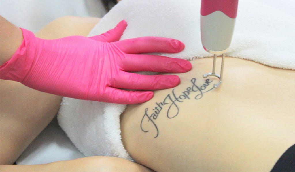 Błędy młodości – jak pozbyć się niechcianego tatuażu?